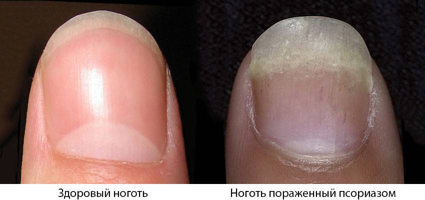Уход за кожей при псориазе