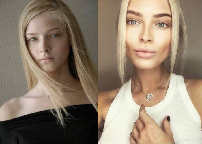 Алена шишкова – до и после пластических операций + фото