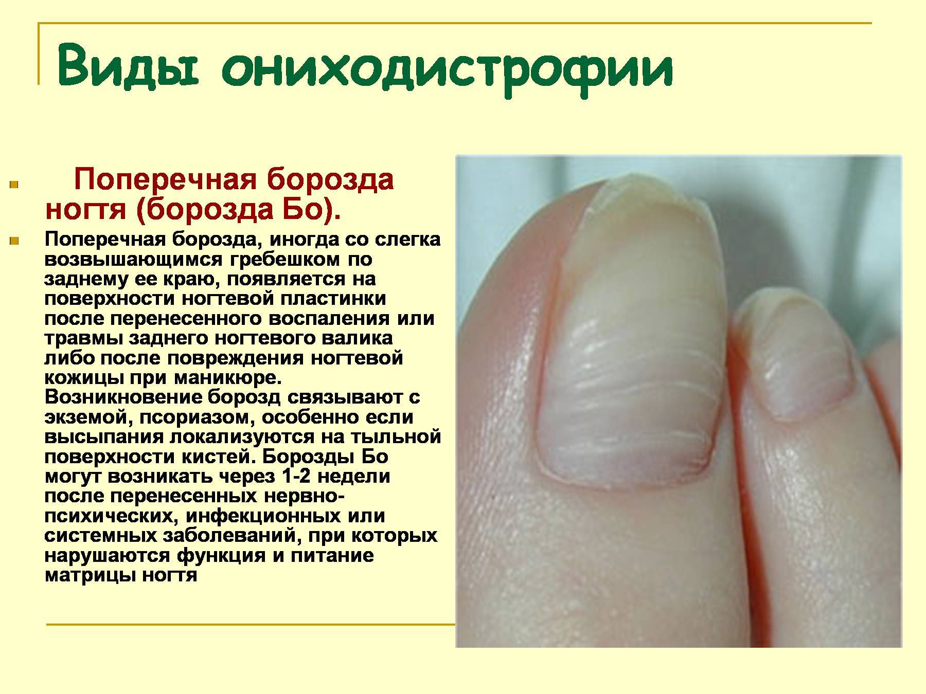 Избавление от онихорексиса (продольное расслоение) ногтевой пластины в центре подологии podolab