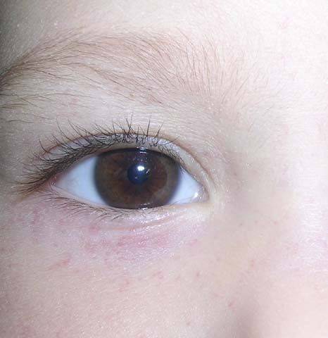 Пигментный ретинит у ребенка: причины, диагностика, симптомы