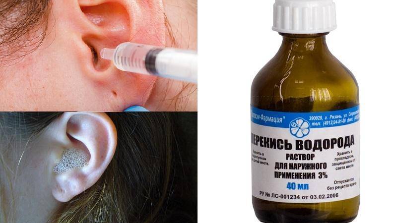 Ушная серная пробка: симптомы, осложнения, диагностика, лечение