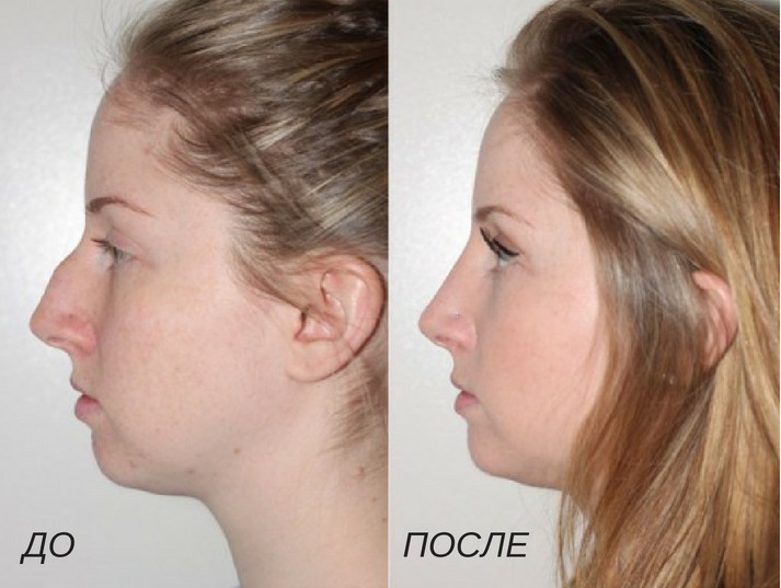 Пластика носа (ринопластика): стоит ли делать? - клиника в уручье