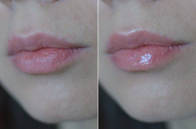 Увеличение губ гиалуроновой кислотой ❤️ блог anacosma