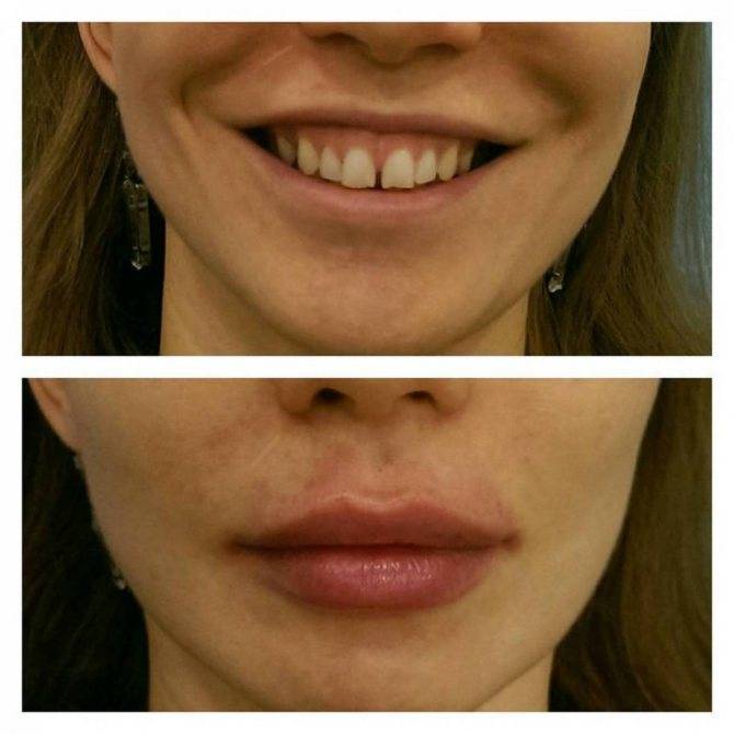 Увеличение губ гиалуроновой кислотой – 5 ошибок процедуры