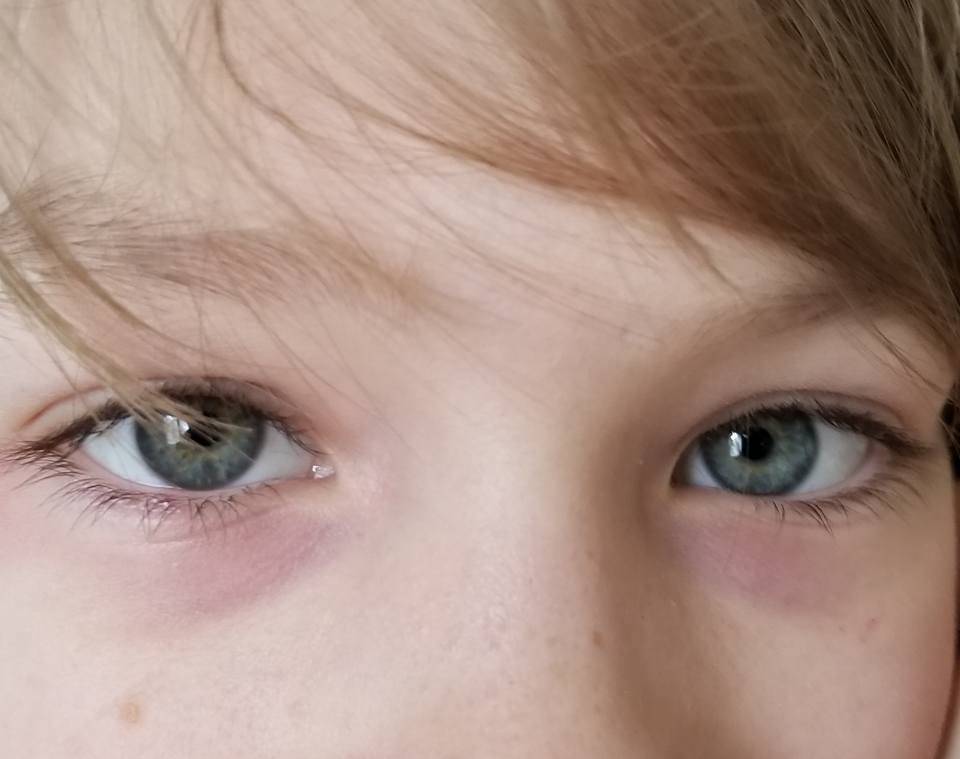 У ребенка под глазами красные круги - почему краснота и розовые пятна: комаровский о покраснениях, причины