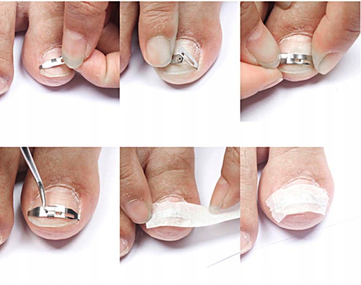 Краевая резекция ногтевой пластинки — клиника "виромед"
