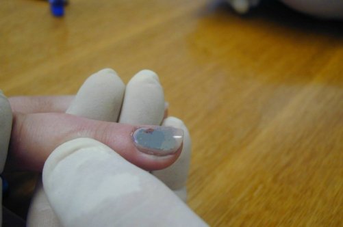 Почему ногти синеют причина. Меланома подногтевой гематомы. Подногтевая гематома на ноге. Подногтевая гематома на большом пальце.