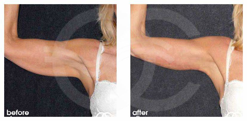 Реабилитация после липофилинга (ягодицы, лицо, грудь) - процесс восстановления