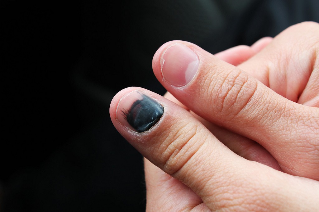 Повреждение сухожилий разгибателей пальцев и кисти - kinesiopro
