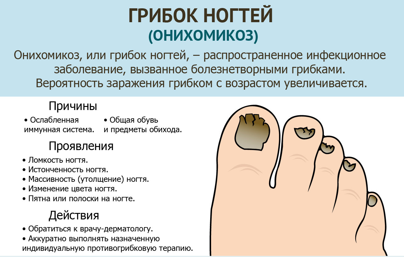Лечение грибка ногтей. как будут выглядеть ногти после процедуры?