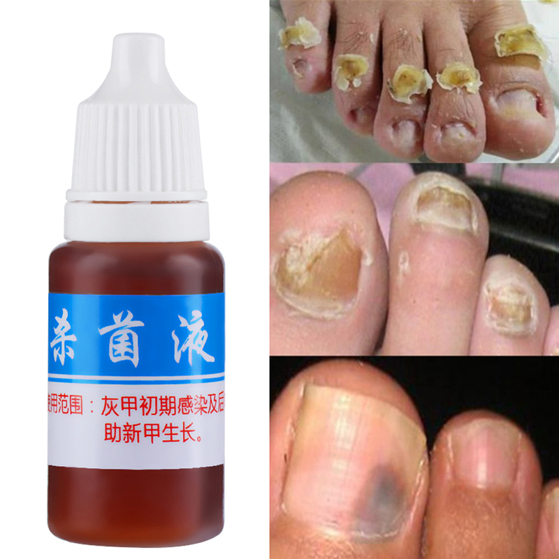 Эффективное лечение грибка ногтей эфирными маслами