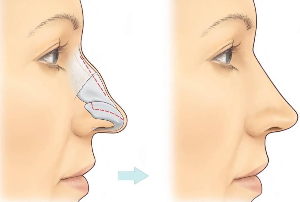 Как скорректировать большой нос: способы уменьшения носа без операции и с помощью пластической хирургии