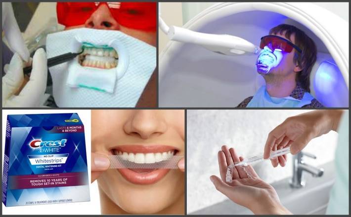 «мифы» о процедуре отбеливания | стоматологическая клиника президент на сухаревской