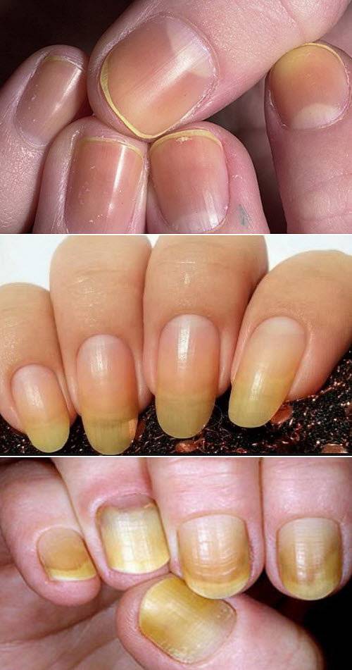 Скорая помощь: выясняем, почему ногти становятся желтыми и, что с этим делать