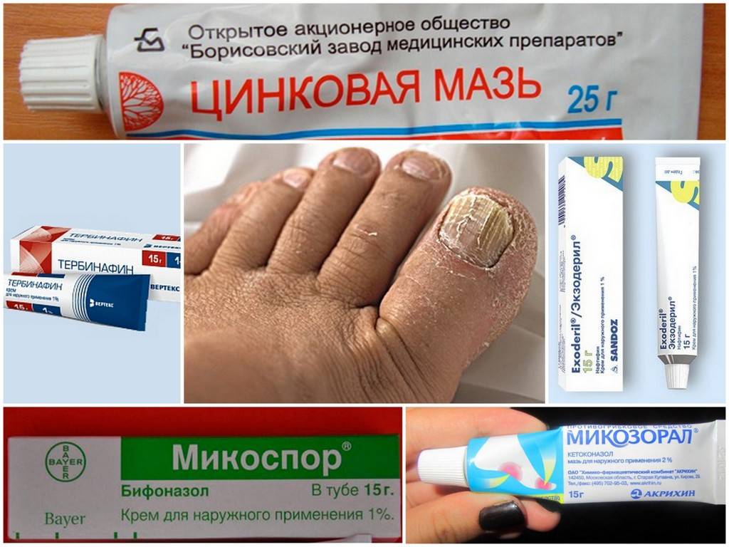 Лечение паховой эпидермофитии у мужчин и женщин, фото - medside.ru