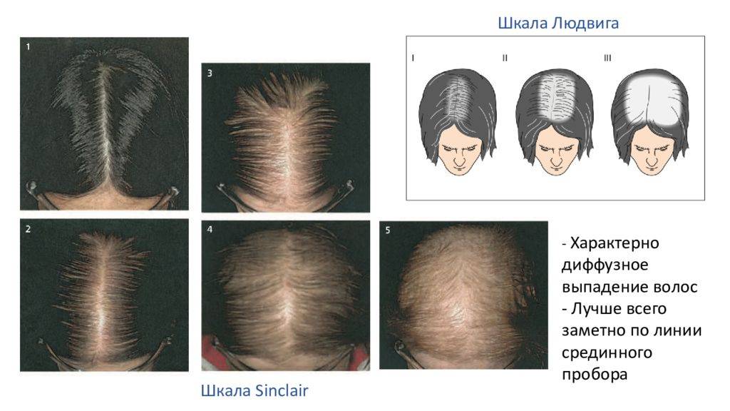 Диффузная линия. Шкала Людвига алопеция. Андрогенетическая алопеция шкала Людвига. Андрогенетическая диффузная алопеция. Ага андрогенная алопеция.