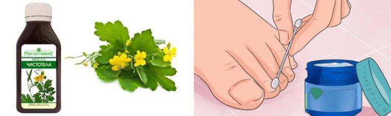 Масло чистотела от грибка ногтей на ногах и способ лечения