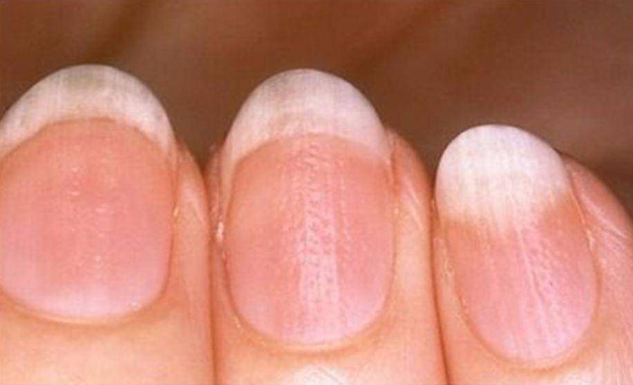 Причины ребристых ногтей на руках: внешние и внутренние проблемы