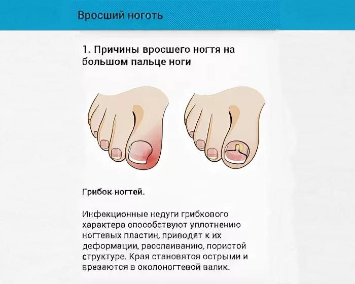 Болезни ногтей на ногах таблица и лечение - кгбуз горбольница №12