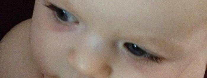 Почему у ребенка круги под глазами: возможные причины? что делать, если у ребенка появились темные круги под глазами?