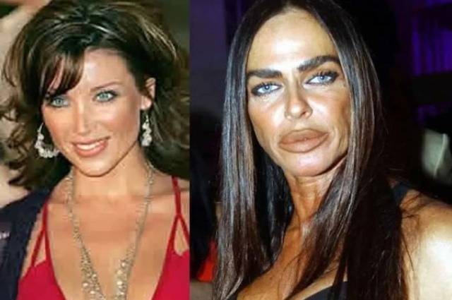 Жертвы пластической хирургии. фото до и после: знаменитости россии и звезды по всему миру, мужчины и женщины