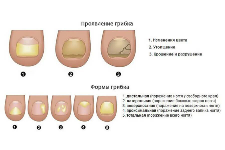 Как распознать грибок ногтей на ногах