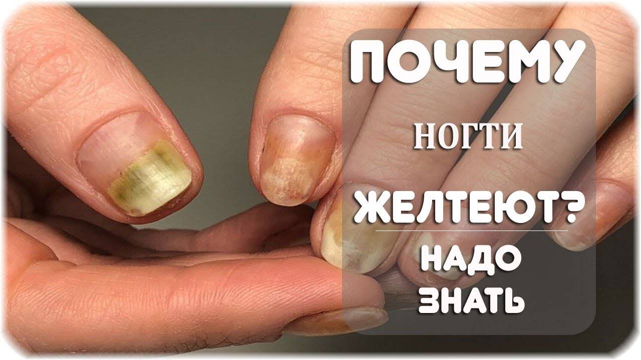 Диагностика по ногтям пальцев рук: по цвету форме структуре