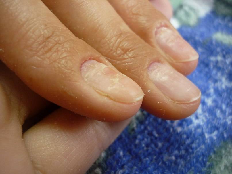 Ониходистрофия ногтей - лечение заболевания препаратами и народными средствами