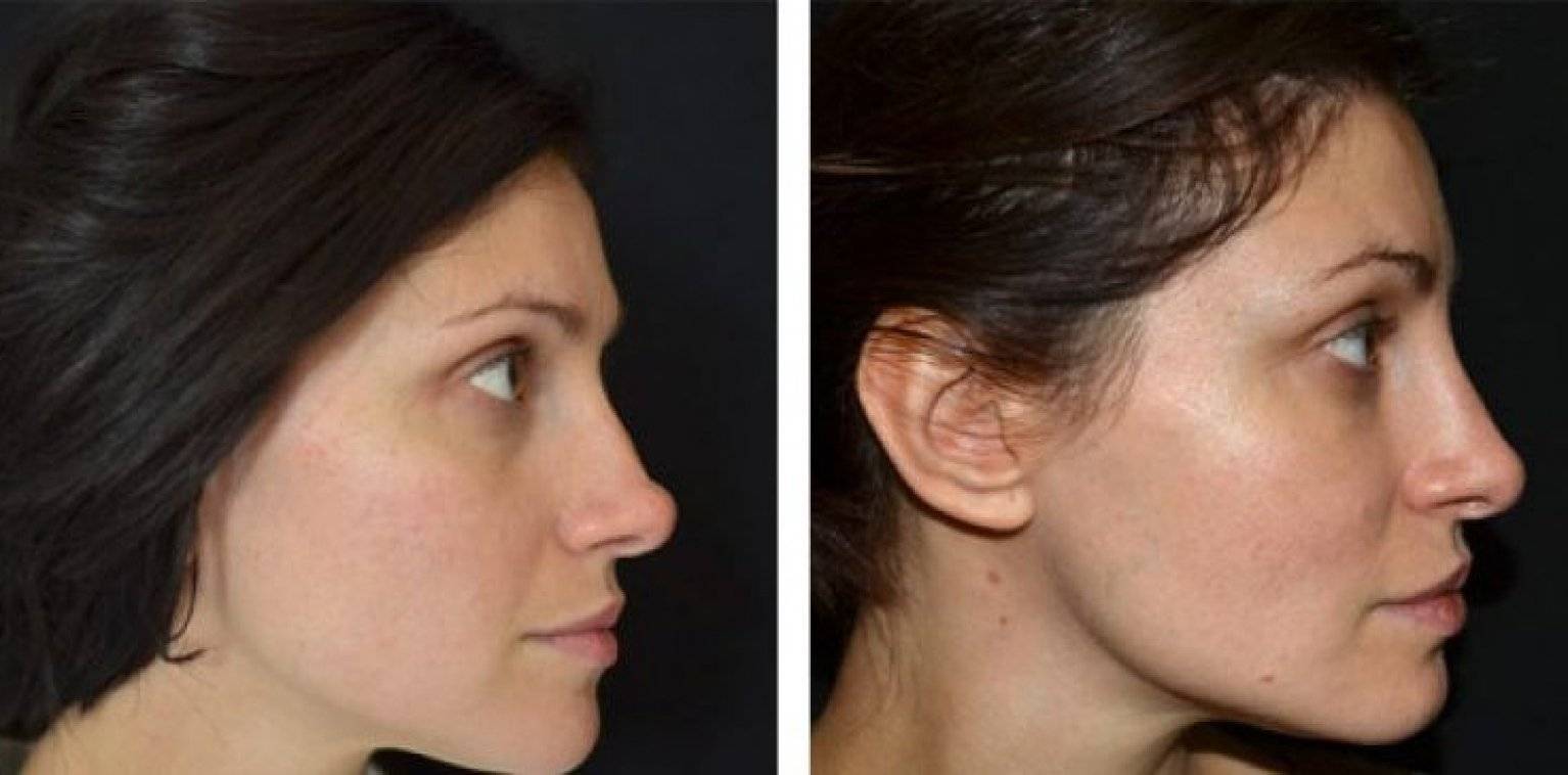 Коррекция носа филлерами: фото до и после, а также аспекты процедуры