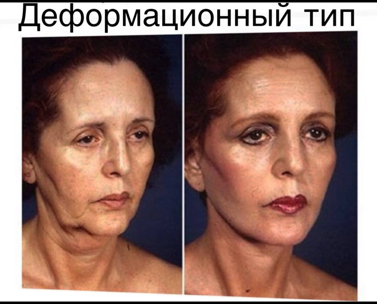 ᐈ птоз верхнего века ~【причины, лечение в киеве】