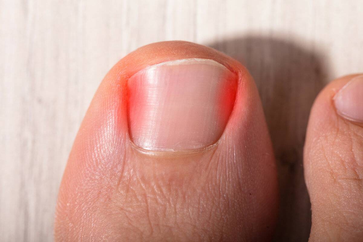 Боль после удаления вросшего ногтя