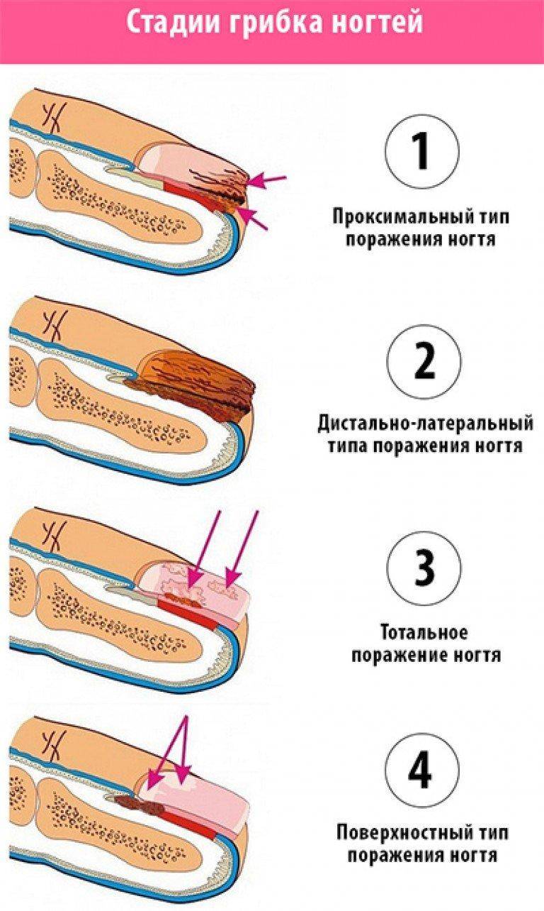 Обработка ногтей от грибка, онихомикоза в центре подологии podolab