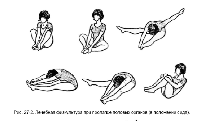 Гимнастика при опущении матки. Опущение матки лечебная физкультура. Лечебная гимнастика по Атабекову при опущении органов малого таза. Гимнастика при опущении стенок влагалища. Лечебная гимнастика кегеля при опущении матки.