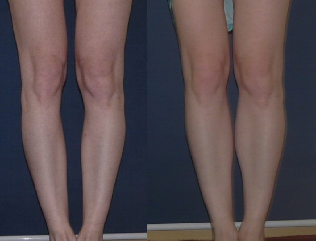 Деформирующий артроз коленного сустава | артракам