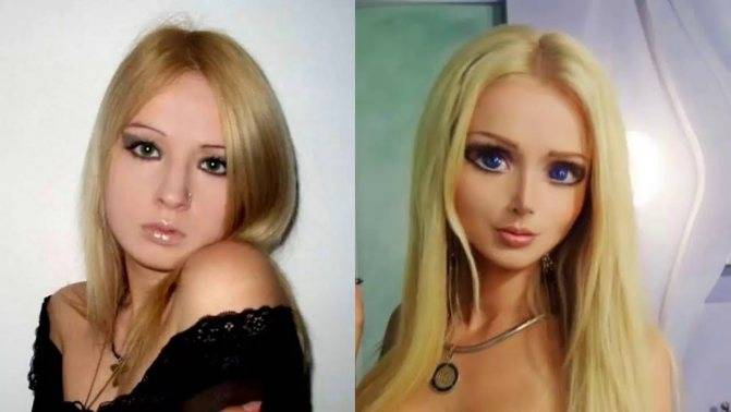 Валерия лукьянова до и после пластики: фото
