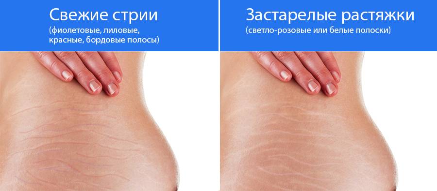 Растяжки на коже. причины, симптомы и лечение растяжек!