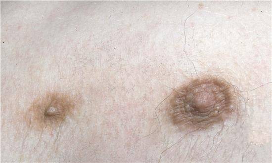 Гинекомастия у мужчин: фото, лечение без операции
