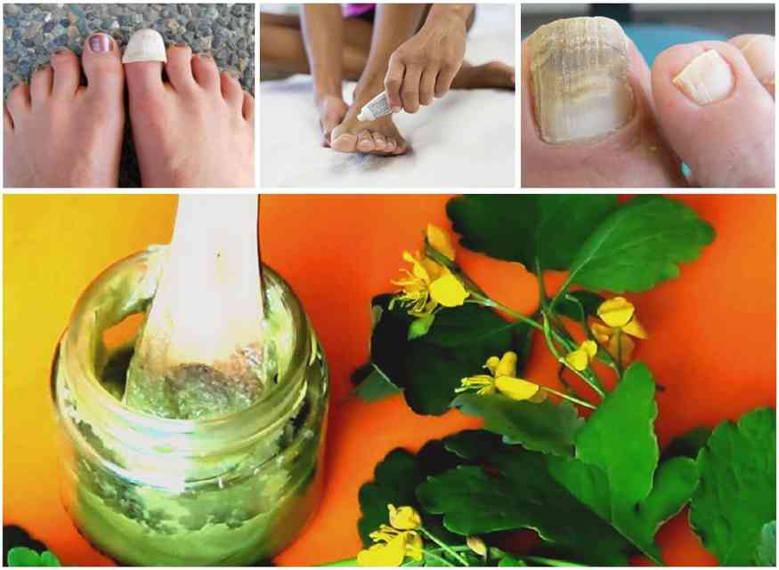 Лечение маслом и соком чистотела грибка ногтей на ногах