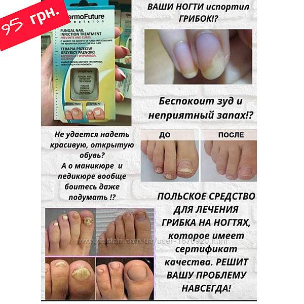 Микозы: симптомы, лечение и профилактика грибка ногтей и кожи