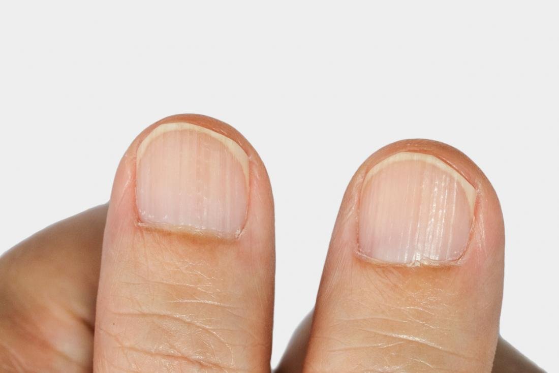 Ребристые ногти на руках причины у женщин и лечение фото