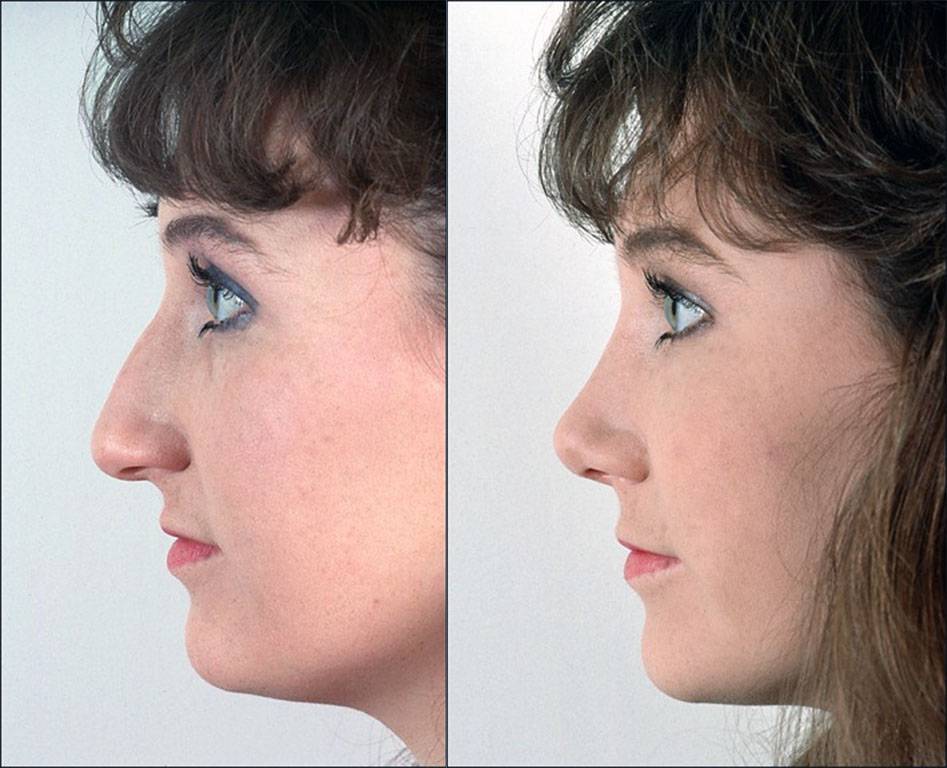 Как сделать ноздри меньше - большие или широкие ноздри | проблемы и решения