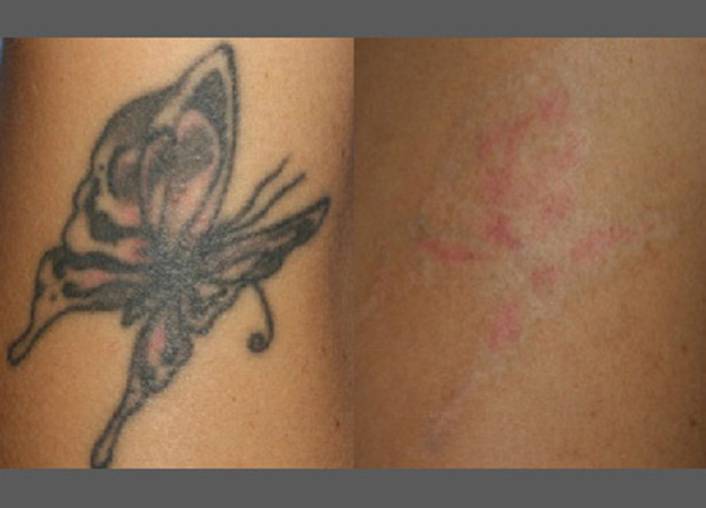 Как свести татуировку: в домашних условиях или лазером?