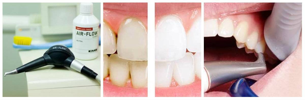 Особенности и преимущества чистки зубов air flow