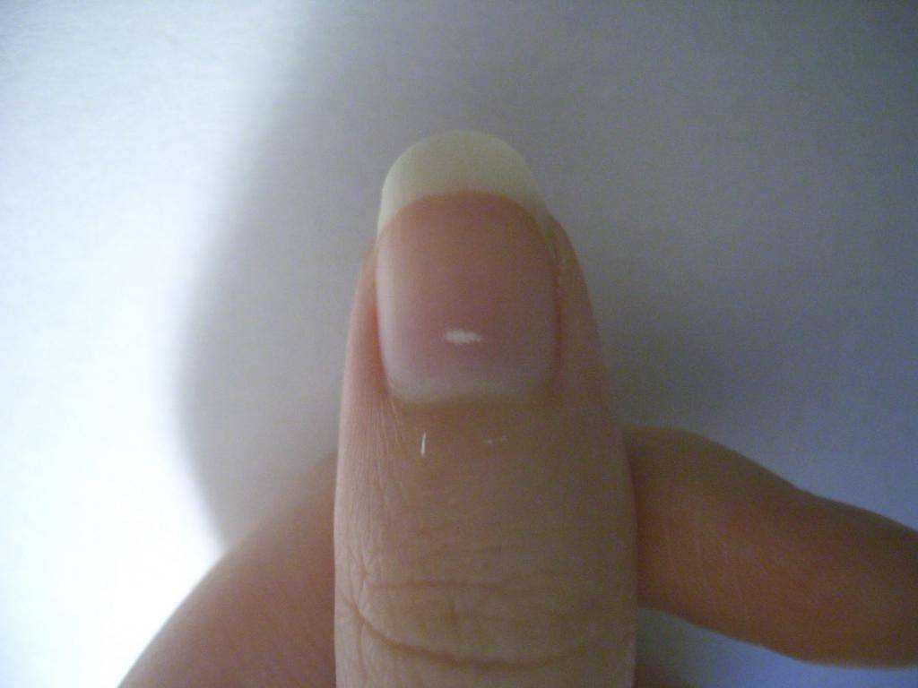 Причины появления белых пятен на ногтях