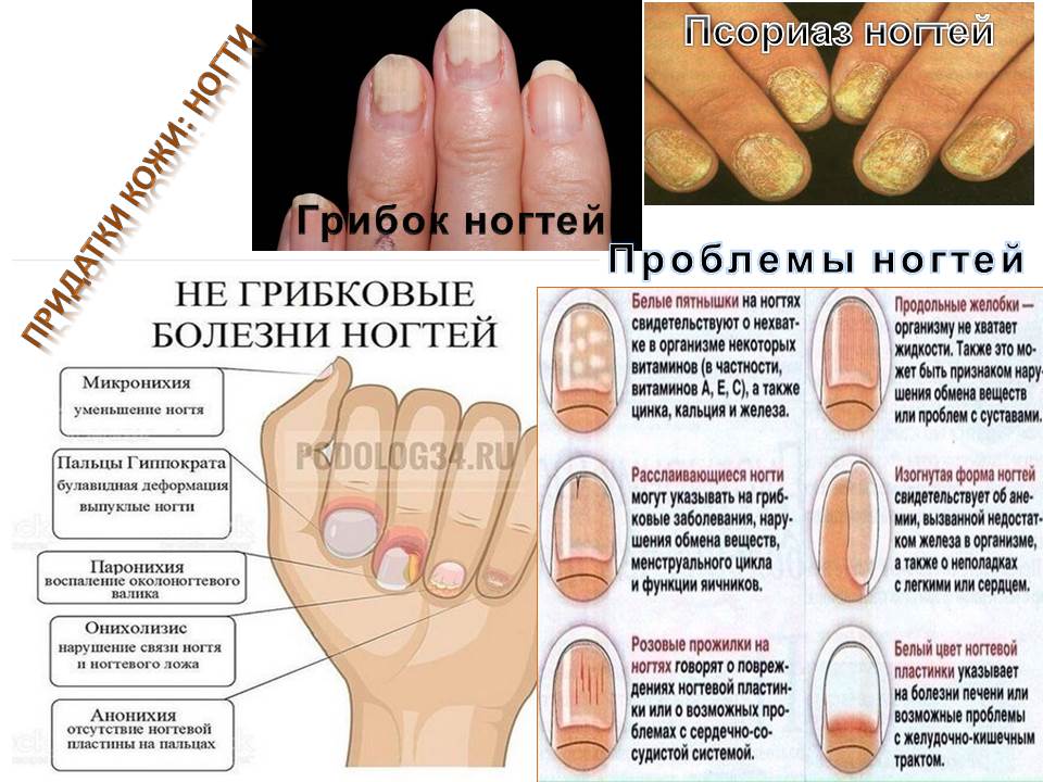5 отличий онихолизиса ногтей от грибковой инфекции