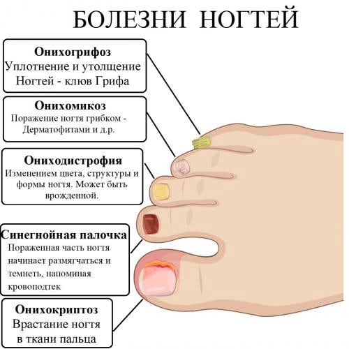 Травма ногтя – необходимые действия