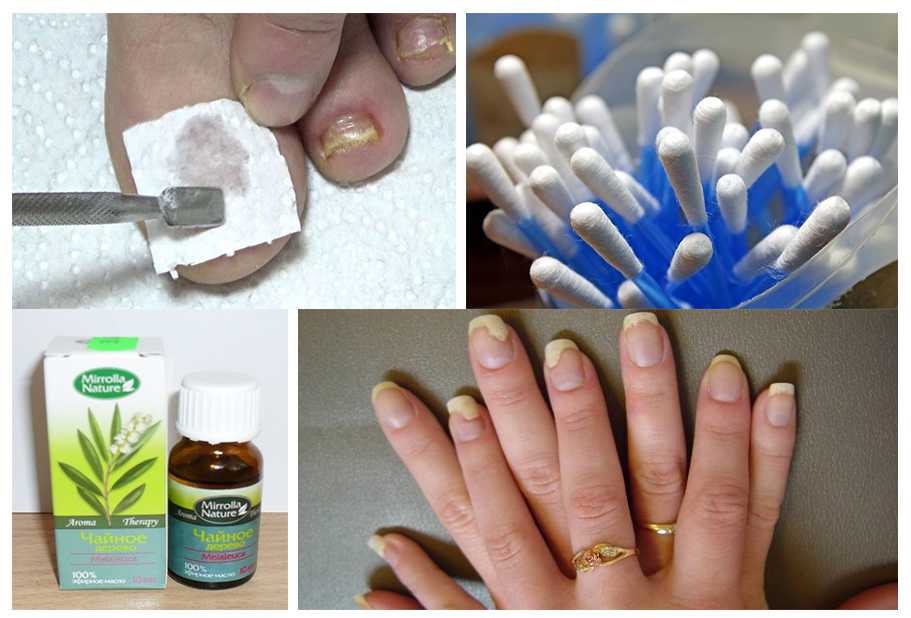 Home Remedies for Red or Swollen Fingernails - WOW Beauty Tips Nail fungus remed