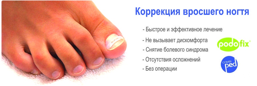 Вросший ноготь на ноге, что делать при вросшем ногте на большом пальце - лечение, удаление проблемы - docdoc.ru