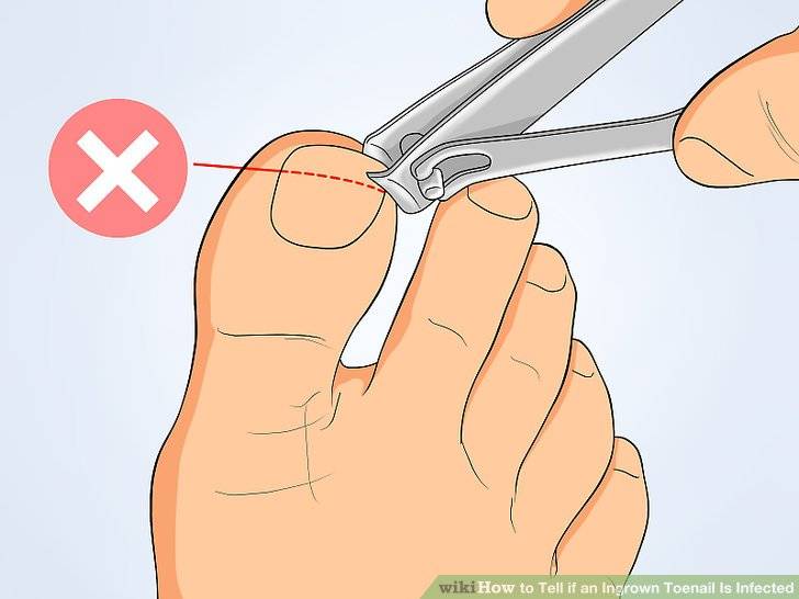 Как правильно стричь ногти на ногах