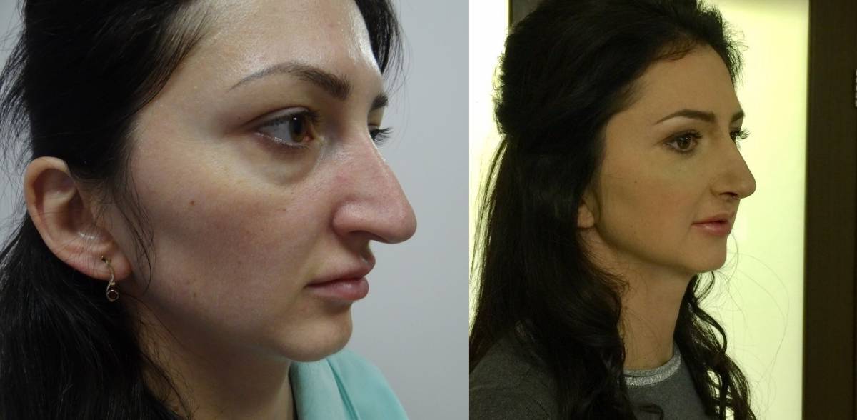 Операция по уменьшению носа: крыльев, кончика, как делают, фото до и после